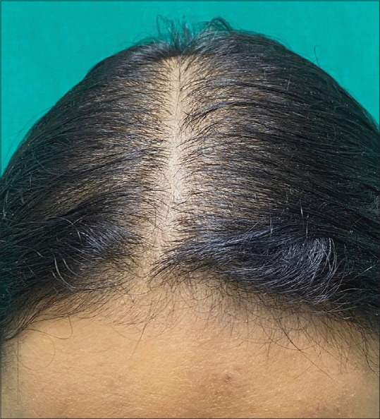Trichotillomania Incognita in an Adult Female: A Great Mimicker Worth Attention!