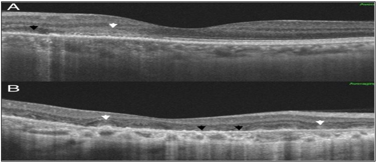 The Role of Adding Intravitreal Dexamethasone Implant to the Standard Management of Serpiginous Choroiditis for Achieving Rapid Remission: A Case Report.