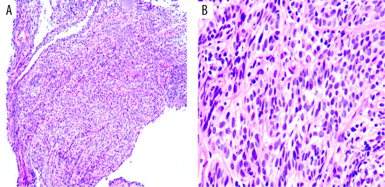 Nasopharyngeal Giant Carcinoma Mimicking Intracranial Lesions: A Case Report and Literature Review.
