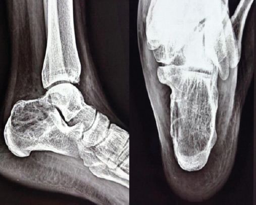 Calcaneal Giant Cell Tumor Masquerading as Lateral Ankle Sprain - A Rare Case Report and Review of Literature.