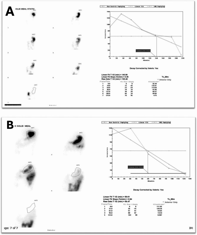 Clinical insights into diabetic gastroparesis: gastric scintigraphy-based diagnosis and treatment outcomes.
