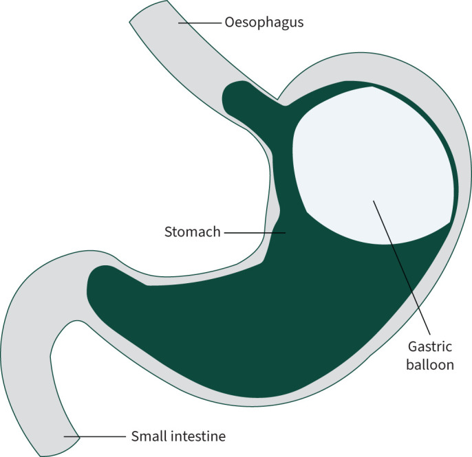 The role of weight management in sleep disordered breathing.