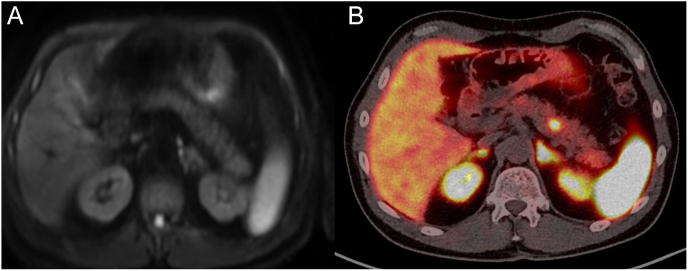 <sup>68</sup>Ga-DOTA-TATE PET/CT improves accuracy and guides management in multiple endocrine neoplasia type 1 (MEN-1) patients with suspected duodeno-pancreatic neuroendocrine tumours.