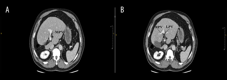 Right Hepatic Lobe Hypoplasia and Gangrenous Cholecystitis: Surgical Implications and Case Report.