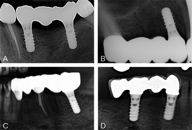 Prognosis of multi-unit implant supported and combined tooth-implant supported fixed dental prostheses: a retrospective cohort study with a mean observation period of 4.27 years.