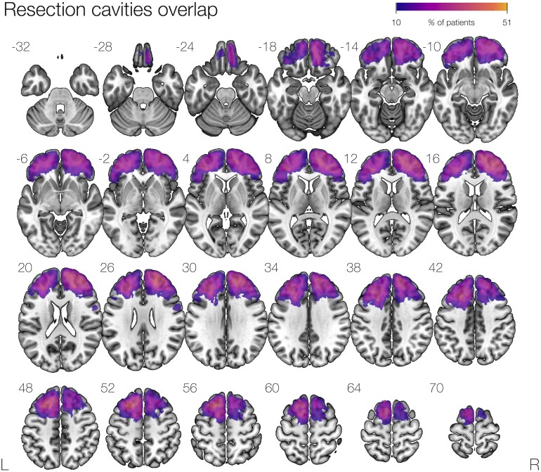 Impact of anterior callosal disconnection on picture naming in frontal lobe epilepsy surgery.
