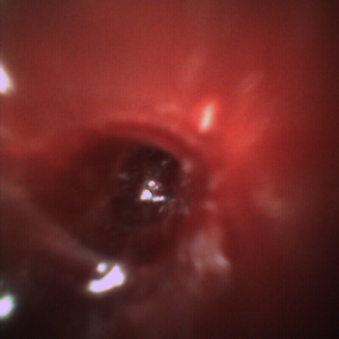 Direct Intranodal Visualization During EBUS-TBNA Using the Iriscope: A Novel Case Series.