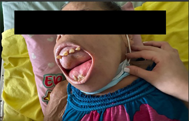 Severe consequences of uncontrolled tertiary hyperparathyroidism in a limited resources setting: a case report.
