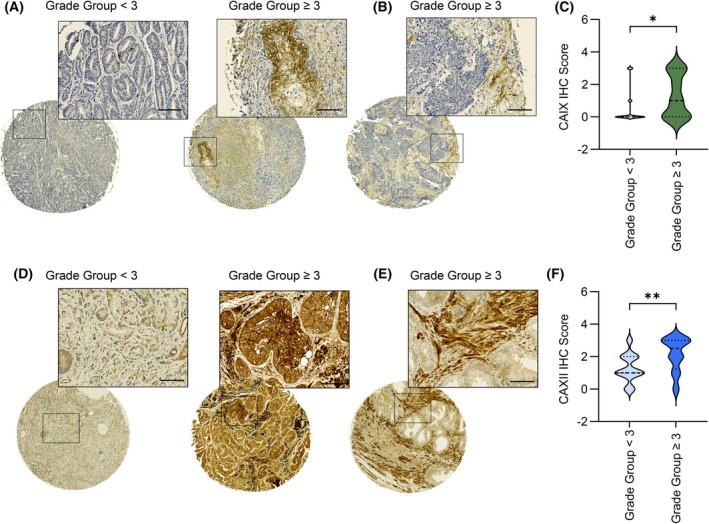 Targeting carbonic anhydrase IX/XII prevents the anti-ferroptotic effect of stromal lactic acid in prostate carcinoma.