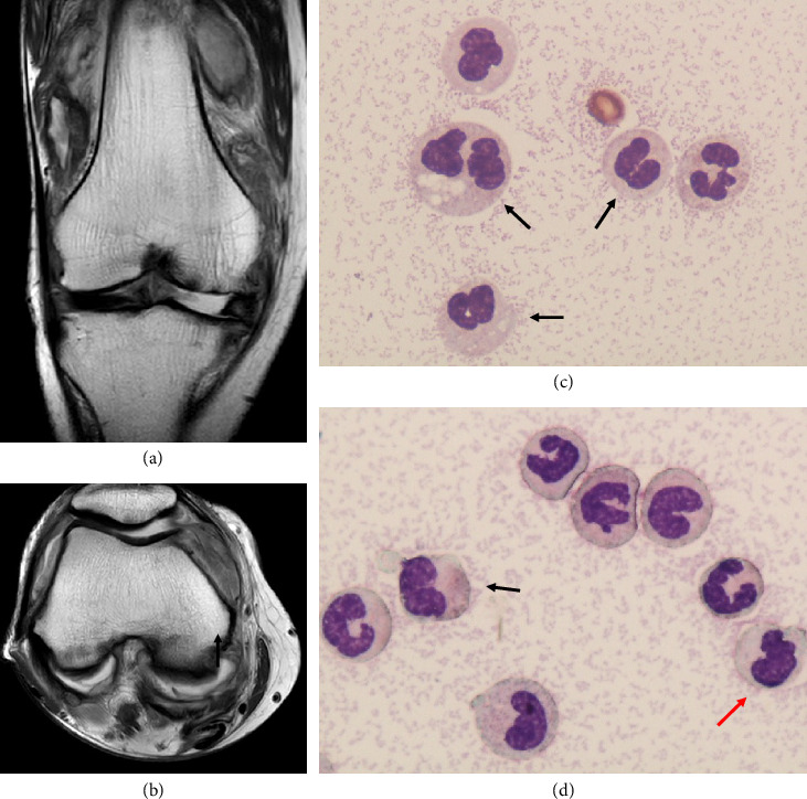 Successful Treatment of Leukemic Synovitis Complicated With Chronic Myelomonocytic Leukemia.