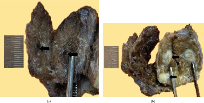 Multifocal Medullary and Papillary Thyroid Carcinoma Occurring as a Collision Tumor: A Case Report.