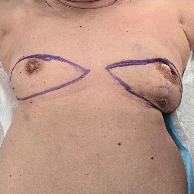 Pedicled transverse rectus abdominis myocutaneous flap removal after 21 years: a case report.