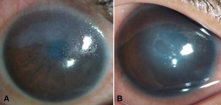 Outcomes of Collagen Crosslinking in Patients with Keratoconus and Co-Existent Limbal Stem Cell Deficiency.