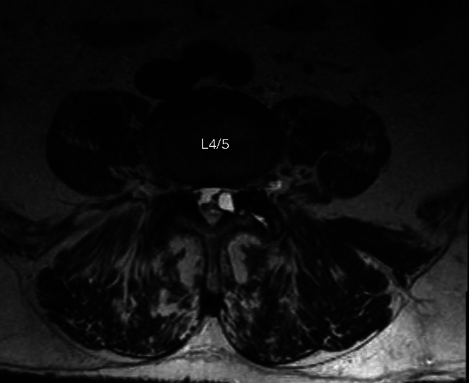 Nocardia facet sepsis, an indicator of immunocompromise: illustrative case.