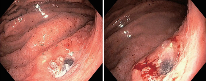 Atypical Gastric Lesion Revealing Underlying Pancreatic Cancer With Direct Invasion.