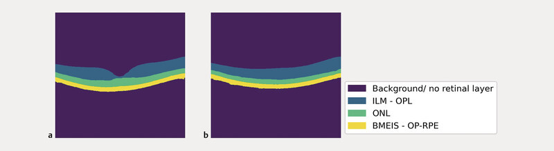 Deep Learning-Based Retinal Layer Segmentation in Optical Coherence Tomography Scans of Patients with Inherited Retinal Diseases.