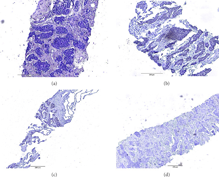 Delayed Pulmonary Metastasis of Basal Cell Carcinoma 10 Years After Primary Excision: A Case Report and Literature Review.