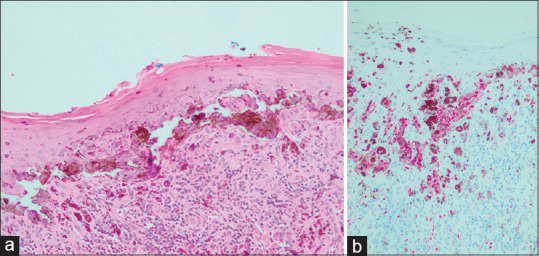Dermoscopic Features of Vulvar Melanoma.
