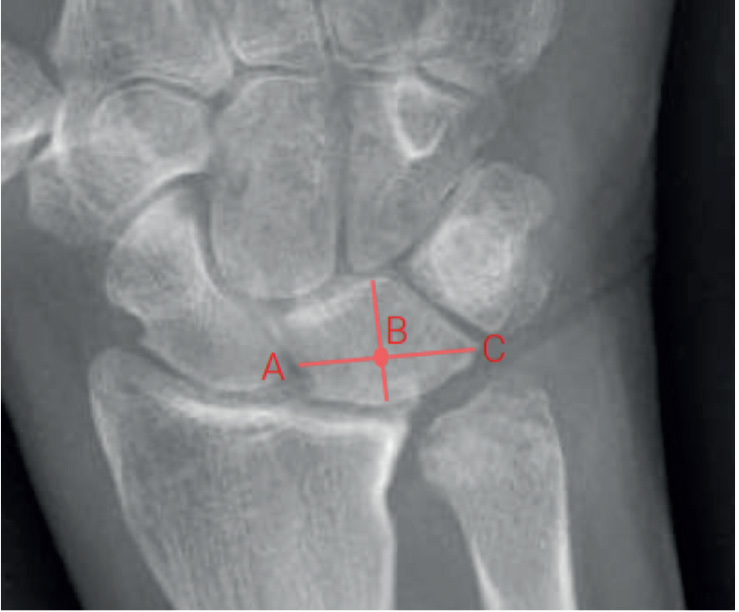Ulnar head replacement or head resection in patients with distal radioulnar arthritis: a prospective cohort study of clinical and patient-reported outcomes up to 2 years after surgery.