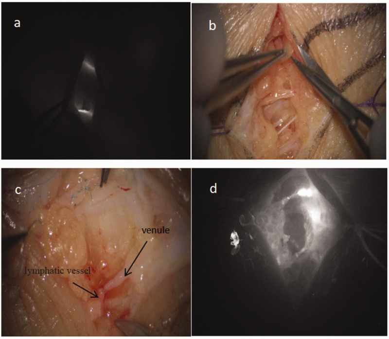 Multiple injections of indocyanine green for improving the outcomes of lymphatic-venous anastomosis reconstruction of lymphatic return under microscopy: A case report.