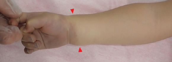 Acute Forearm Compartment Syndrome in a Toddler Caused by Hematoma without Fracture: A Case Report.