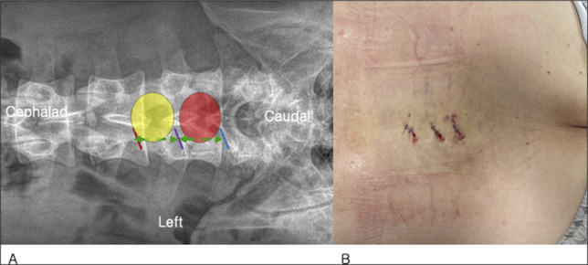 Equivalent Patient-Reported Clinical Outcomes Between Single-Level and Multilevel Biportal Endoscopic Decompression at 5-Year Follow-up.