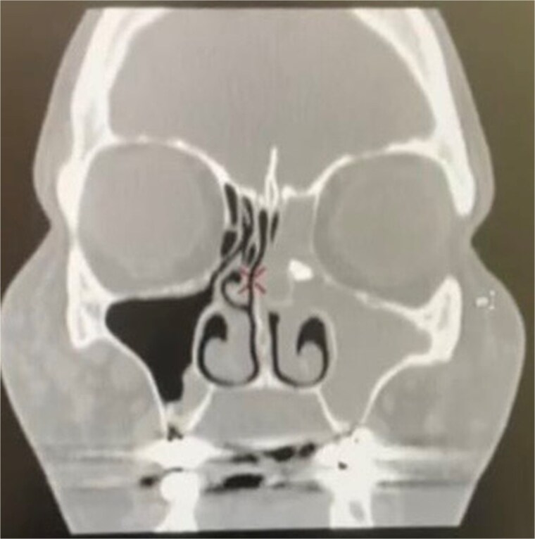 Unusual migration of a tooth root into the ethmoid sinus after dental extraction: a case report and literature review.