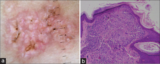Grouped Inflamed and Umbilicated Papules: A Distinct Clinical Presentation of Perforating Sarcoidosis.