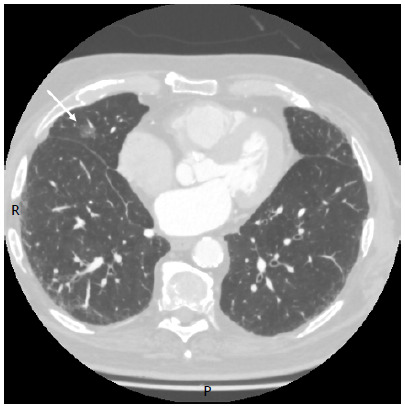 Indocyanine green used in association with a surgical hemostatic agent as a fiducial marker to reduce overflow during robot-assisted thoracic surgery.