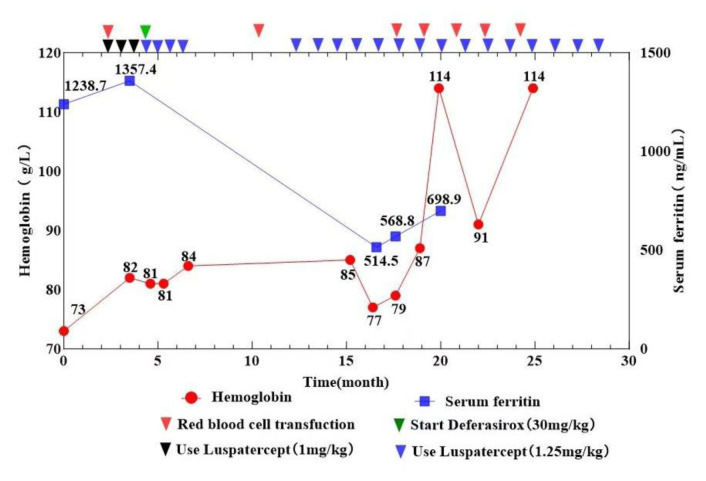 Luspatercept Treatment in a β-Thalassemia Patient with Pulmonary Arterial Hypertension: A Case Report.