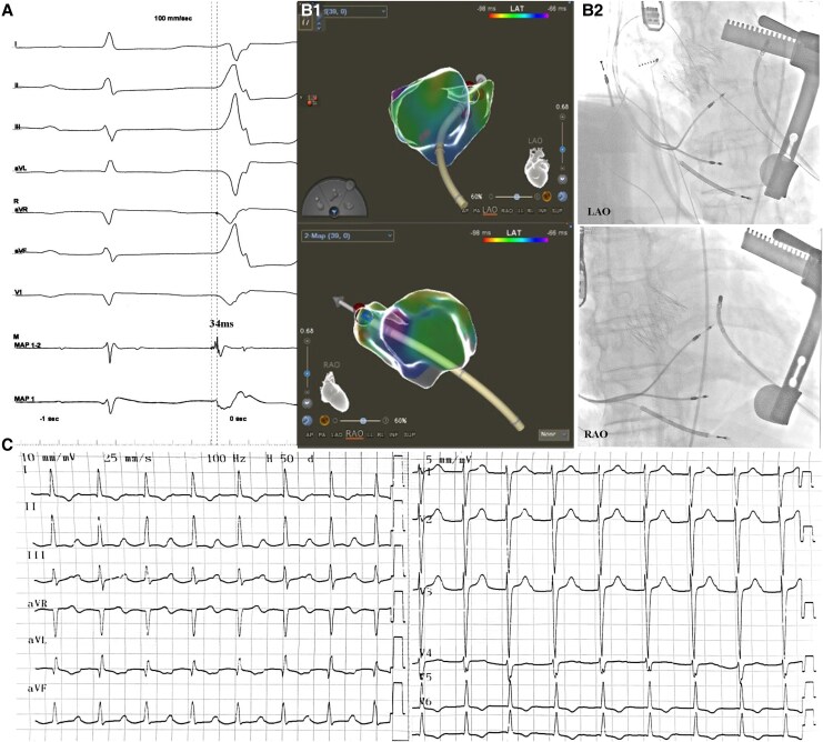Combined transapical transcatheter aortic valve implantation and premature ventricular contraction ablation in a high-risk cardiomyopathy patient: a case report.