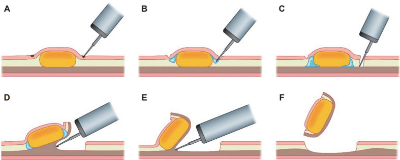 Recent Advances in Endoscopic Treatment Techniques for Subepithelial Lesions.