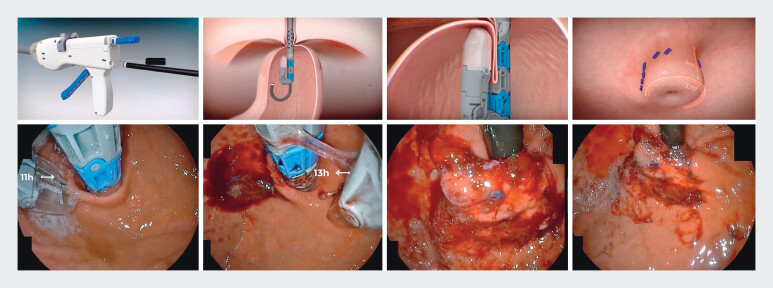 Transoral incisionless fundoplication for patients with gastroesophageal reflux disease after peroral endoscopic myotomy: Prospective cohort.