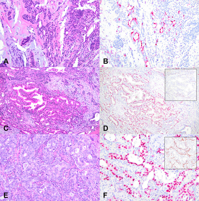 Pleomorphic Adenoma with Epithelial Atypia, Apocrine Metaplasia, and/or In situ/Intracapsular Salivary Duct Carcinoma Are Indolent Lesions with Good Prognosis: A Proposal for Unified Nomenclature and Clinical Observation.