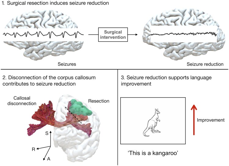 Impact of anterior callosal disconnection on picture naming in frontal lobe epilepsy surgery.