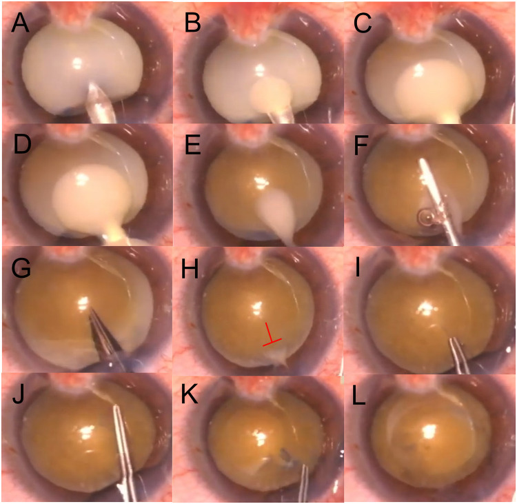 Evaluation of a Modified Single-Stage Continuous Curvilinear Capsulorhexis Technique Using 18-Gauge Needle Decompression in Intumescent Cataracts.