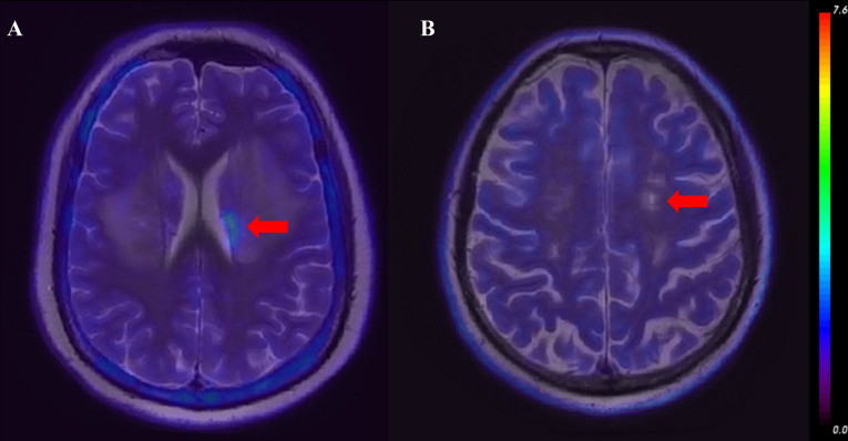 TSPO PET/MR in neuropsychiatric lupus: neuroinflammatory metabolic signatures and diagnostic biomarkers.