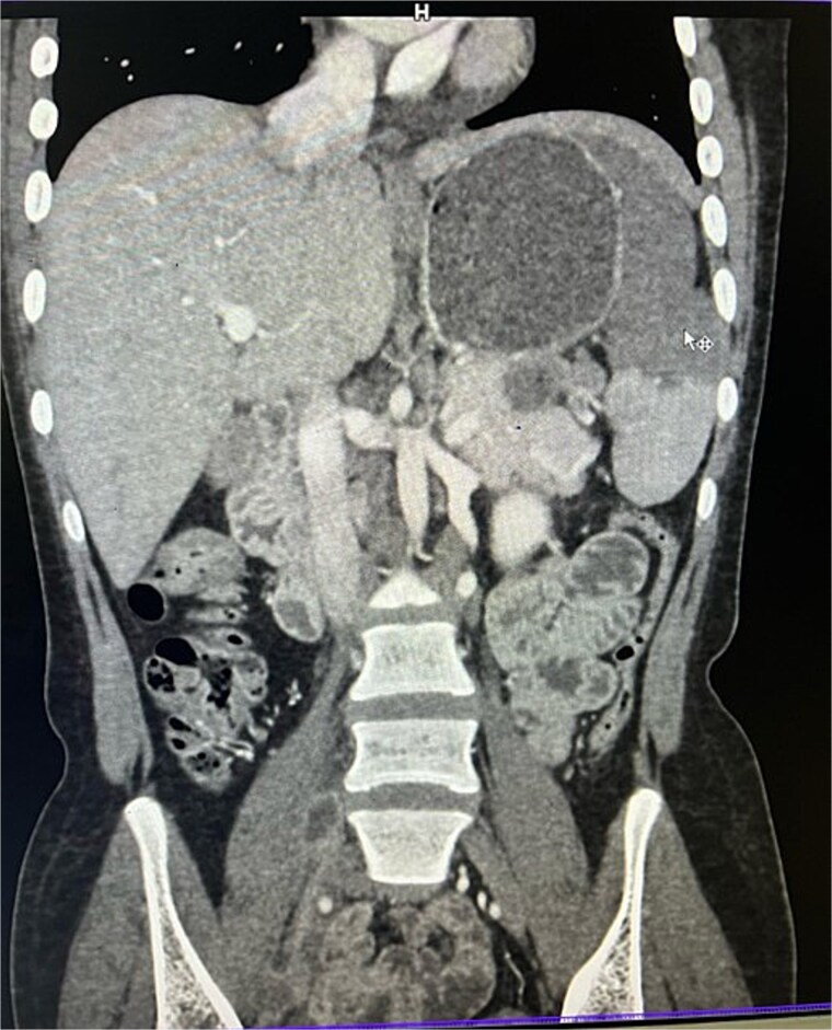 Isolated pancreatic tail and splenic hilum tuberculosis: a rare case report.