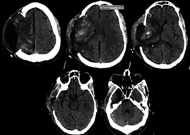 Managing malignant middle cerebral artery infarction with open scalp incision and partial hemispherectomy: illustrative case.