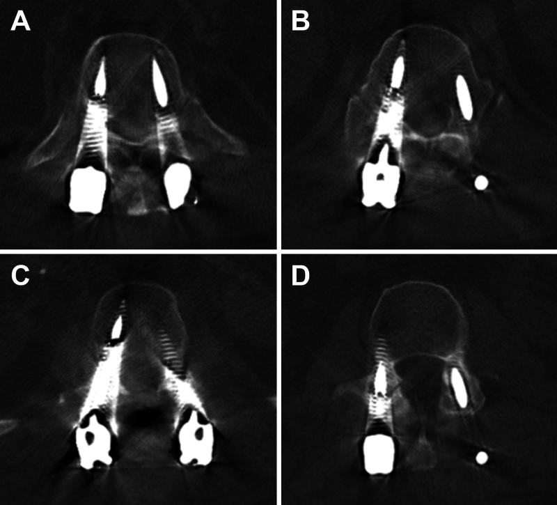 Metal artifact reduction leading to appearance of fractures in pedicle screws: illustrative case.