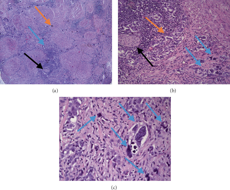 Unusual Type of Acinar Adenocarcinoma of the Prostate With Low PSA: A Histopathological Report of Two Cases of Pleomorphic Giant Cell Adenocarcinoma.