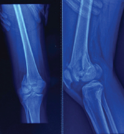 Isolated Double Hoffa Fracture of the Distal Femur without Intercondylar Extension: A Rare Case Report.