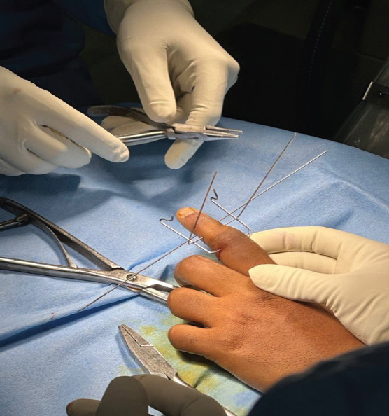 Dynamic External Fixation Using Suzuki Frame for Intra-articular Middle Phalanx Base Fracture with Dorsal Subluxation: A Case Report.
