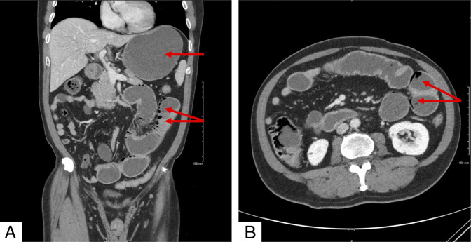 Psyllium Overdose During Bowel Preparation Leading to Pneumatosis Intestinalis.