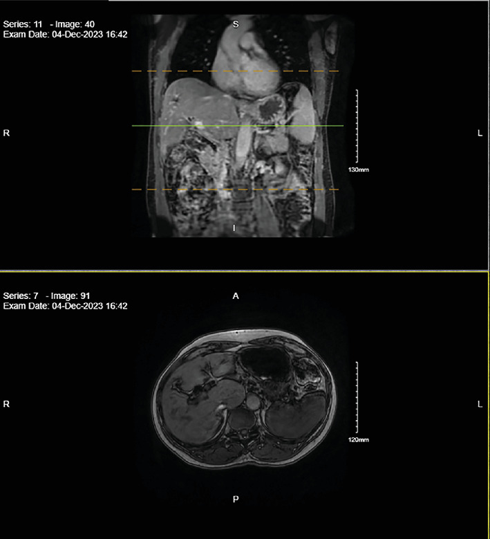 Defying the Prognostic Odds: A Case Report of Unexpected Complete Remission of Metastatic Ampullary Carcinoma With Palliative Chemotherapy.