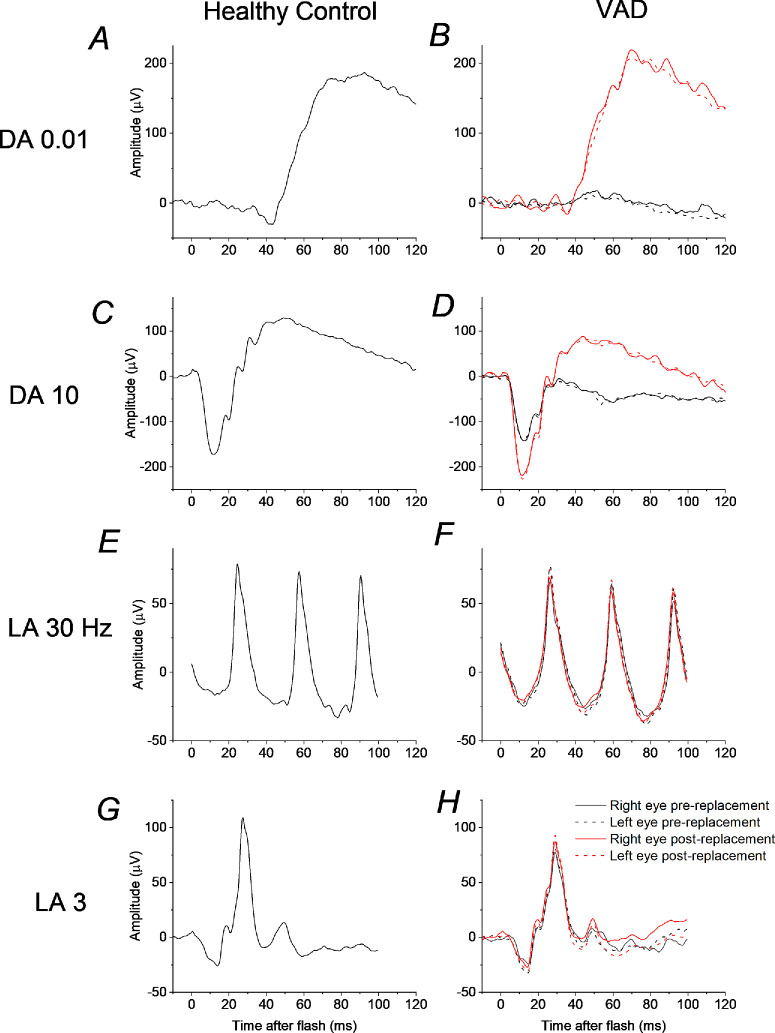 Selective Impairment of Rod-Driven Vision in Vitamin A Deficiency: Insights From Examining the Effect of Desensitizing Backgrounds.