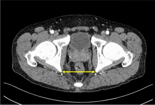 Visceral obesity as a predictor of ileal pouch reachability in ulcerative colitis: A prospective single-center study.