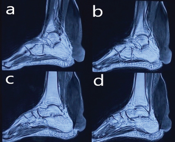Massive Tendo Achilles Xanthoma Treated with en bloc Excision and Reconstruction with Flexor Hallucis Longus Tendon Transfer: A Case Report.