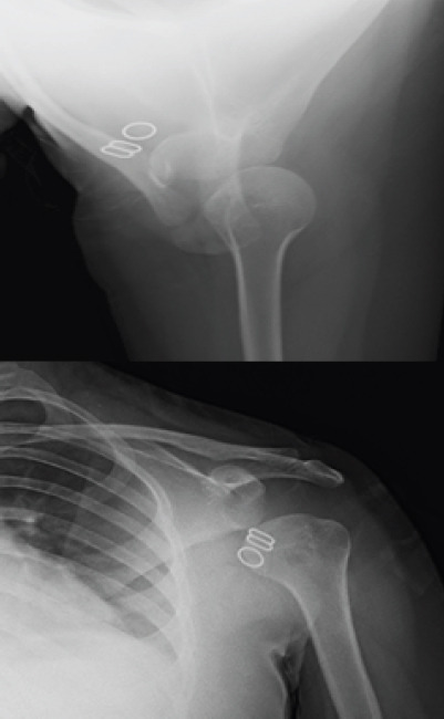Atypical Idiopathic Inferior Functional Shoulder Instability in a 15-year-old Female: A Case Report and Review of Literature.