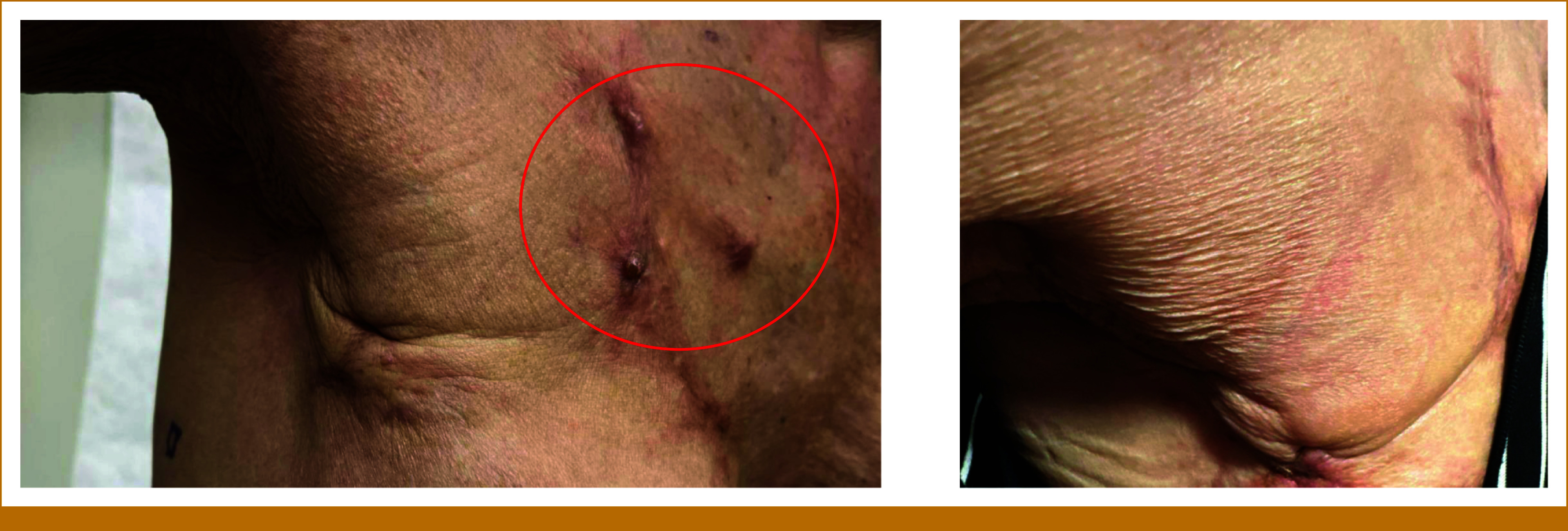 Complete Response With Alpelisib and Trastuzumab in a Patient With Estrogen Receptor-/Progesterone Receptor-Negative, Human Epidermal Growth Factor Receptor 2-Positive Refractory Metastatic Breast Cancer.
